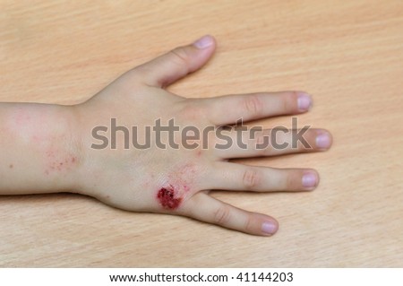 Hand Allergy