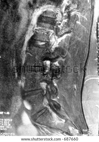 MRI back herniated disc herniation medical