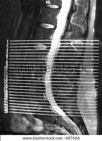 MRI back herniated disc herniation medical
