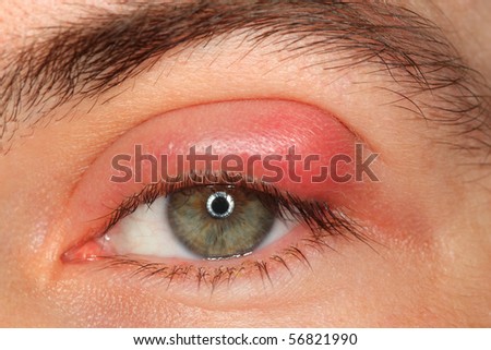 illness person eye with sty and pus looking into the camera