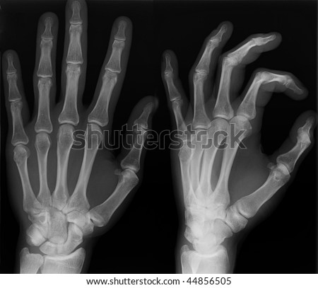 Left hand x-ray shoot in two versions.