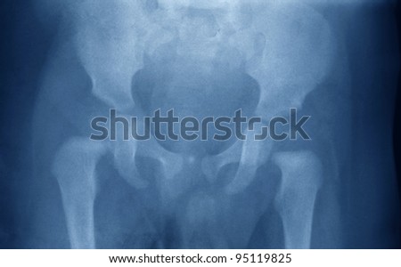 X-Ray of the pelvis and both hips of a little boy, a horizontal picture