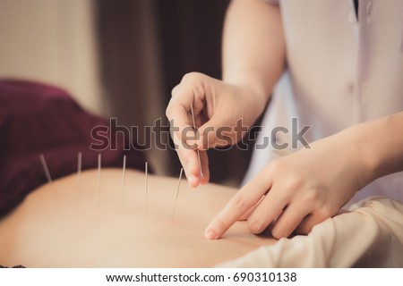 Adult male physiotherapist is doing acupuncture on the back of a female patient. Patient is lying down on a bed and is covered with royal blue towels.