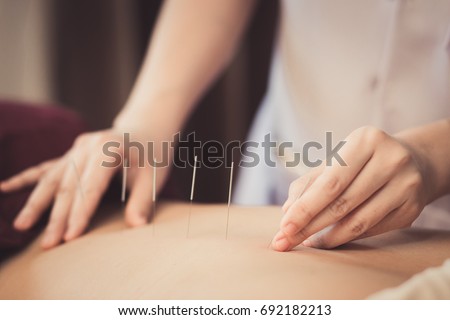 Adult male physiotherapist is doing acupuncture on the back of a female patient. Patient is lying down on a bed