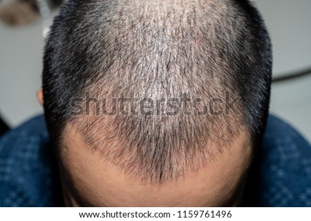 Top view of a man\'s head with hair transplant surgery. Bald head of hair loss treatment.