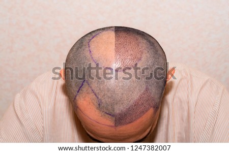 Top view of a man's head with hair transplant surgery with a receding hair line. - Before and After  Bald head of hair loss treatment.