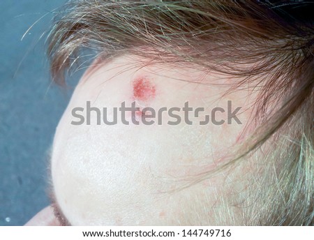 Male person with wound on forehead under the hair bang