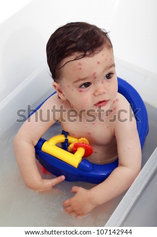 Baby with chicken pox having bath to sooth itchiness