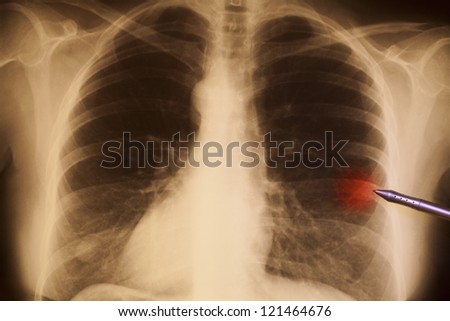Human chest X-ray, illuminated by a light-box
