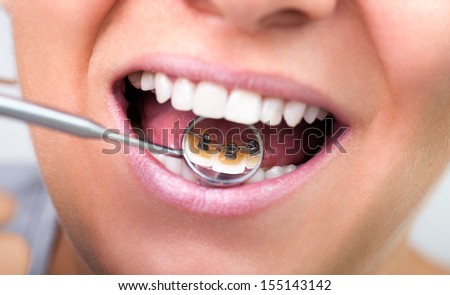 Woman Showing Invisible Lingual Braces On Dental Mirror