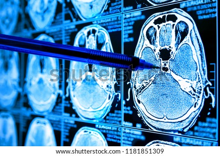 Artificial intelligence in smart healthcare hospital technology concept. Doctor point pen to AI biomedical algorithm screen and machine learning detect brain Pneumonia , cancer cell in X-Rays process.