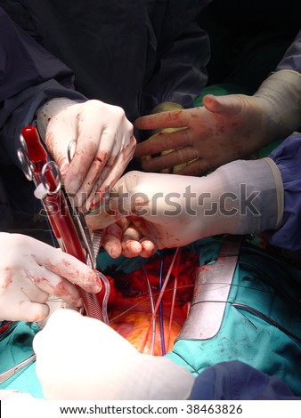 a surgical intervention,heart surgery