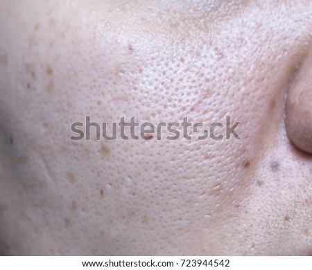 Woman 's problematic skin , acne scars ,oily skin and pore and blackhead on the face.