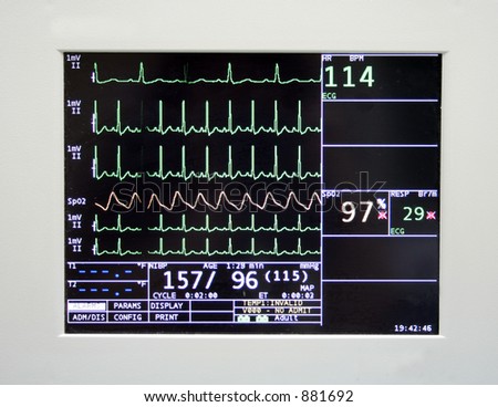 Cardiac monitor displaying patient\'s ekg tracing