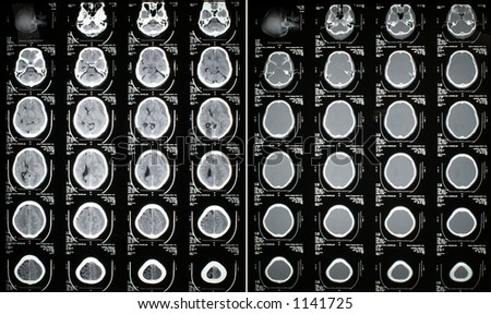 Head CT Scan Result - Subdural Hematoma  Brain (Left) and Skull (Right) Slices
