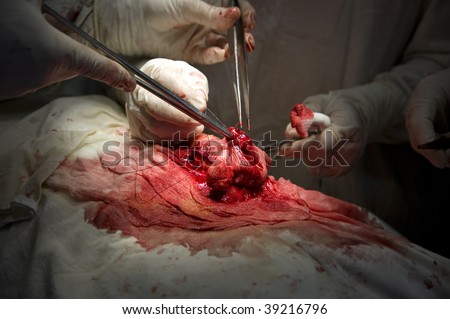 surgeon making new urinary bladder from a small twisted intestine segment.