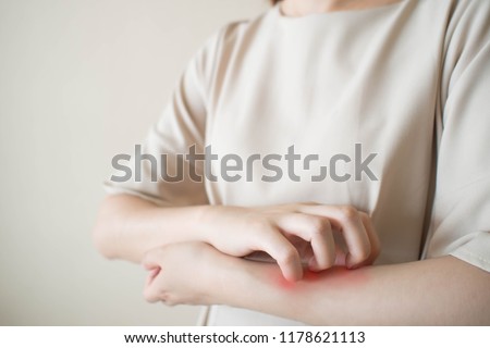Young woman scratching arm from having itching. Cause of itchy skin include insect bites, eczema, dermatitis, food/drugs allergies or dry skin. Health care concept. Close up.