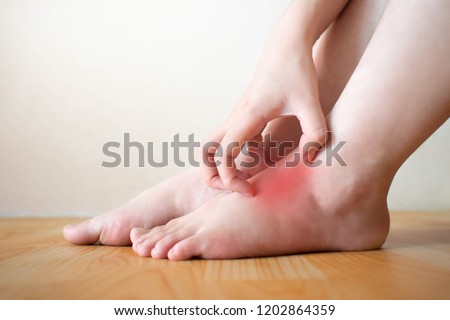 Young woman scratching the itch on her feet w/ redness rash. Cause of itchy skin include athlete\'s foot (fungal infection), dermatitis (eczema), psoriasis, or bug bites. Health care concept. Close up.