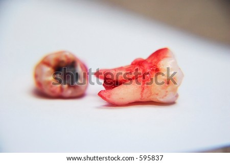 Pulled Tooth