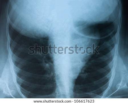 Chest X-ray medical image.