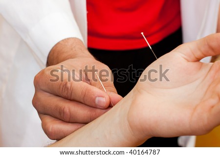 A Chinese medical doctor performs acupuncture on a patients arm and hand