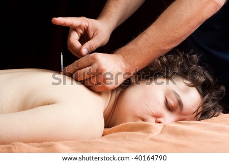 A Chinese medical doctor performs acupuncture on a patients back