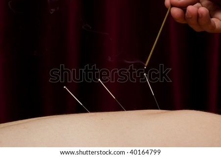 A simple image of an acupuncture patients back with three needles and a Moxa stick with smoke