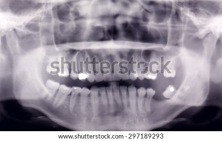 Panoramic Dental X-Ray Of Human Teeth, selective focus.