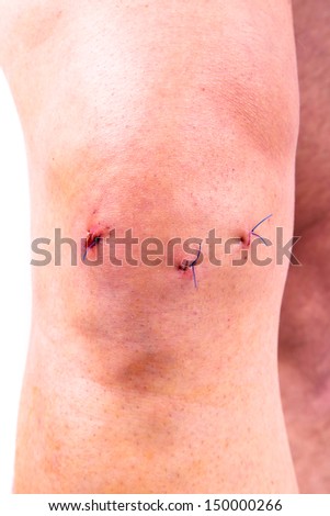 Man knee after arthroscopic surgery with stitches