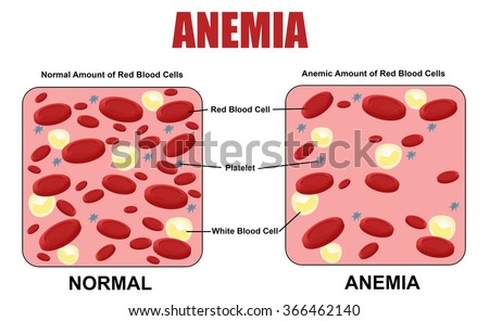 Anemia Diagram, Vector Illustration (for Basic Medical Education, For 