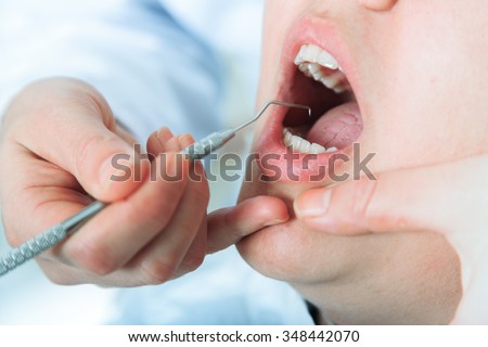 Close-up of patients open mouth during oral checkup with mirror near by.Dentist curing a female patient