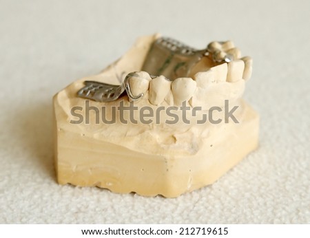 Dental metal framework for partial denture on cast model