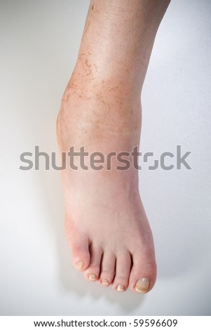 ankle sprain isolated on white background