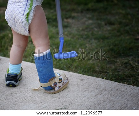Small child with broken leg in cast