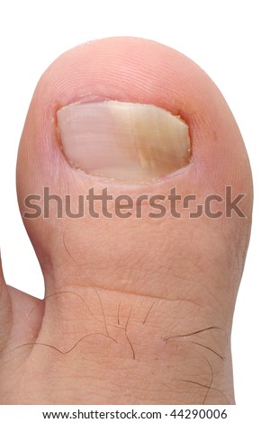 Close up image of right foot toe nail suffering from fungus infection