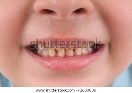 rotten children teeth