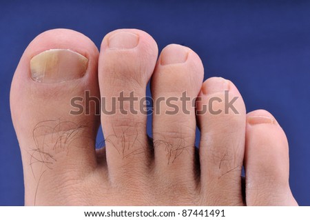 Right foot toe nail suffering from fungus infection