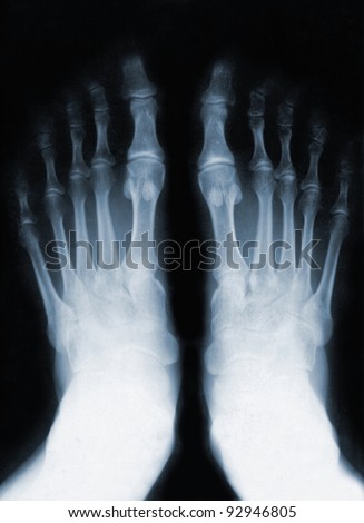 foot finger fracture