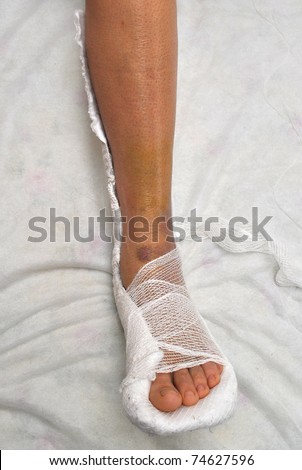 Patient with broken leg in cast
