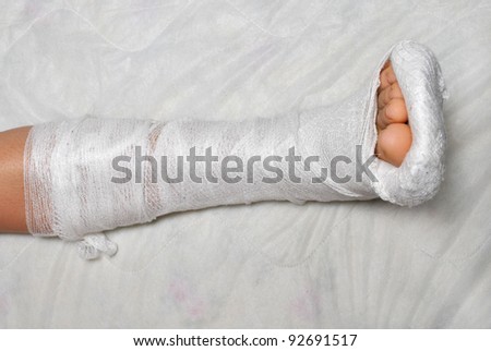 Patient with broken leg in cast