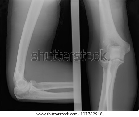 X ray image of broken human elbow