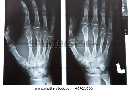 x ray hand. stock photo : human hand x-ray
