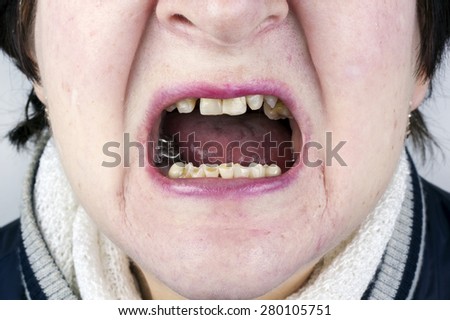 The elderly woman shows the destroyed erased crumbled teeth and defective skin. Art focus