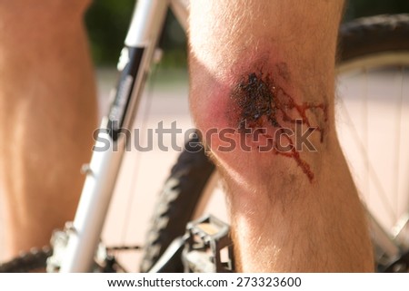 Man with a wound on his knee