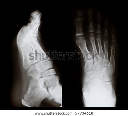 Original x-ray image of a foot, front and side view