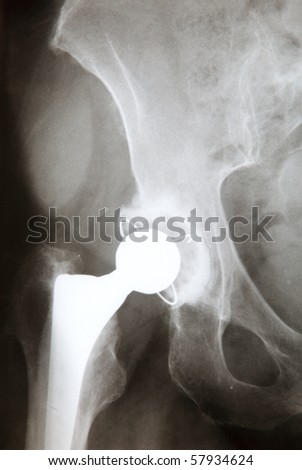 Original x-ray image of woman\'s leg with an artificial hip