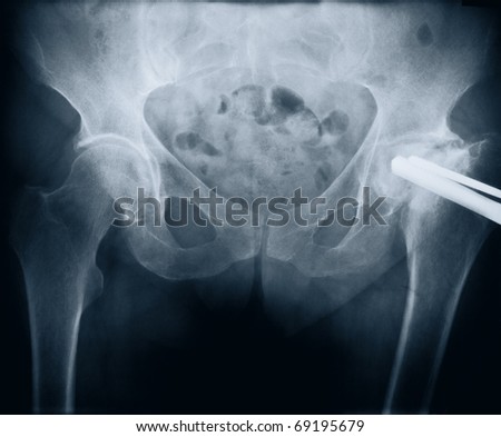 X-ray of a woman\'s pelvis with bolt