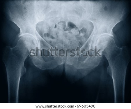 X-ray of a woman\'s pelvis