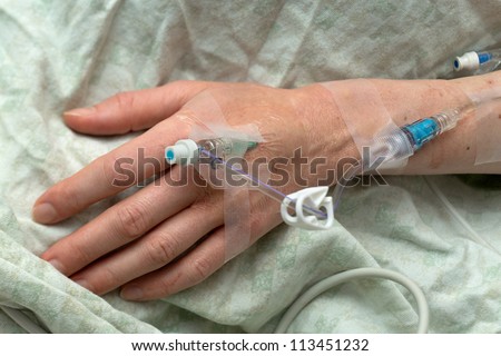 A woman\'s hand with intravenous needle and tubes for medication during surgery