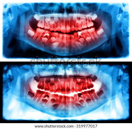 Panoramic dental x-ray of child of seven (7) years. Blue and red colors image roentgen teeth upper and lower girl skull. Two versions positive and negative shots of the digital image